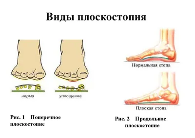 Студия Osteo.Family - Вальгусная деформация стоп. Что это такое? ⠀ Вальгус  проявляется заваливанием стопы в области голеностопного сустава к  внутренней ее поверхности. При этом пятки выворачиваются наружу. Ноги у  ребенка становятся буквой