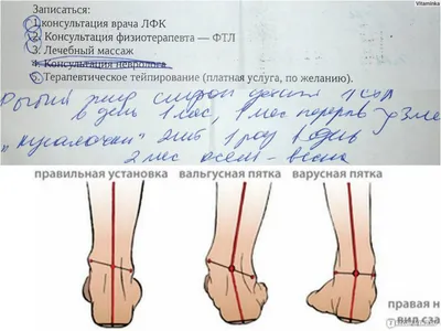 Какими могут быть первые признаки неправильного развития стопы у ребенка? |  ORTHOBOOM - детская ортопедическая обувь | Дзен