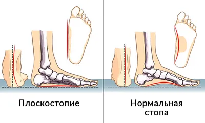 Первая Городская Клиника - У грудного ребенка стопа плоская - это  физиологическая норма до трех лет. Формирование свода стопы начинается  вместе с первыми шагами малыша и заканчивается к семи-девяти годам.  Постепенно жировая