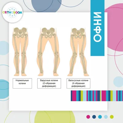 Как определить патологию стоп у ребенка — блог интернет-магазина Orthoboom