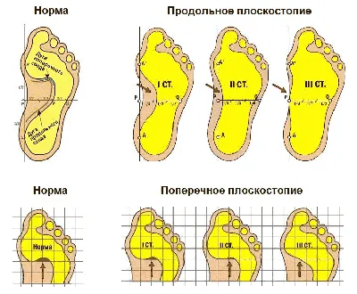 Что вызывает и как исправить деформацию стопы у ребенка?