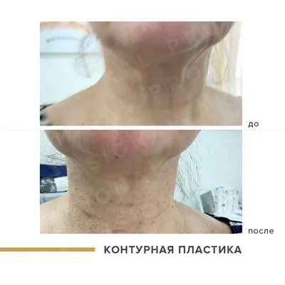 Косметолог Кучерова Нина - 💉Препарат «Радиесс» (Radiesse) – это инъекции  для омоложения кожи. ⠀ Он разглаживает морщины и увеличивает объём мягких  тканей на лице и теле. ⠀ ☝🏼Его состав отличается от состава