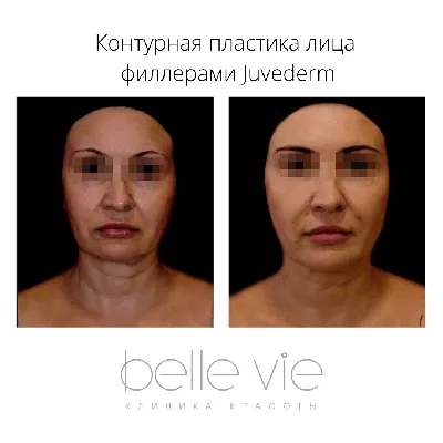 Контурная пластика лица препаратом Juvederm Ultra Smile 0,55 мл в  Краснодаре: цены и отзывы | клиника Belle Vie