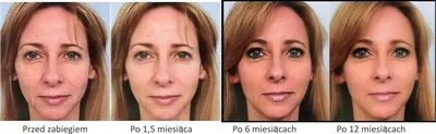 Sculptra® - Olan Estetyka