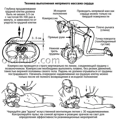 Непрямой массаж сердца