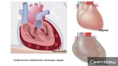 Ответы Mail.ru: Чем отличается прямой массаж сердца от не прямого? (см.)
