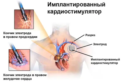 Энциклопедия - Первая помощь при остановке сердца