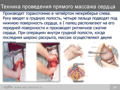 Внутренний (прямой, трансторакальный) массаж сердца