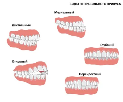 прикусывание щеки после протезирования - Ортопедия - Стоматология для всех