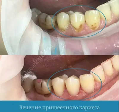 Лечение пришеечного кариеса у Екатерины Косаревой / Лечение зубов / Блог