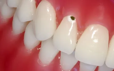Лечение кариеса: выполненная работа с фото до и после в стоматологии OneDent