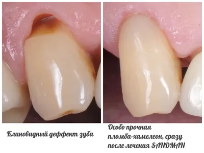 Лечение кариеса в Минске цены в стоматологии Стомика