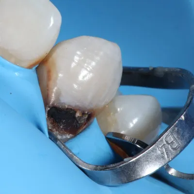 Новые методы лечения пришеечного кариеса зуба. Без сверления.