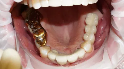 Новые методы лечения пришеечного кариеса зуба. Без сверления.