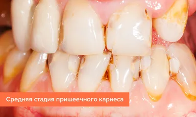 Как лечить пришеечный кариес зубов | Smile Factory