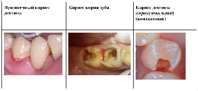 Пришеечный кариес - лечение, фото, причины, стадии