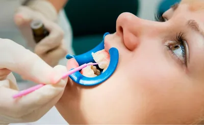 Лечение пришеечного кариеса зубов в Москве | Стоматологическая клиника  «Лаки Смайл»