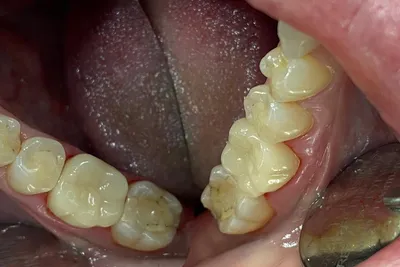 Кариес между зубами лечение, виды межзубного кариеса, цены.