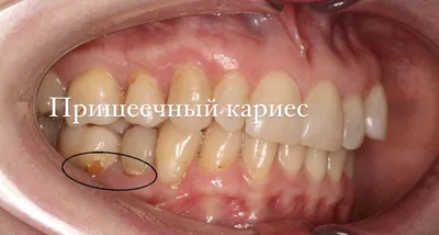 ПРИШЕЕЧНЫЙ КАРИЕС ЛИКВИДИРОВАН! - Стоматологическая клиника Лазурит