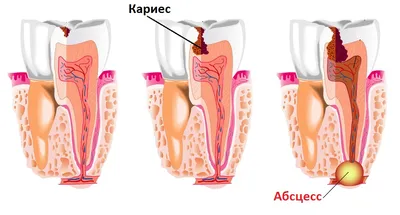 Межмышечный абсцесс