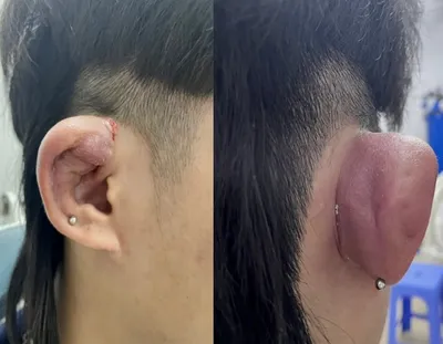 Абсцесс ушного хряща после множественного пирсинга уха - Vietnam.vn