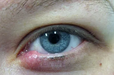 Не болезнь, а проклятие: как быстро вылечить ячмень на глазу | DOCTORPITER