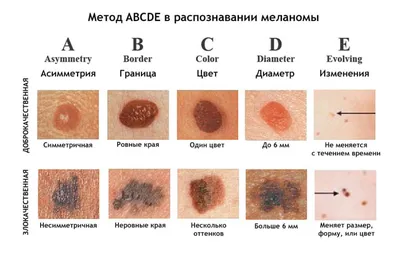 Признаки меланомы кожи фото фото