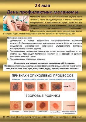 Меланома кожи - симптомы, диагностика и методы лечения | Daily Medical