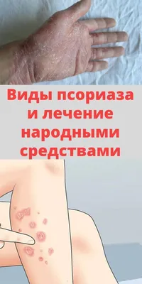 Псориаз: лечение клеточными препаратами - Coolaser Clinic