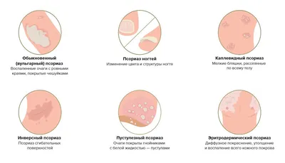 Псориаз на руках - Vitimed