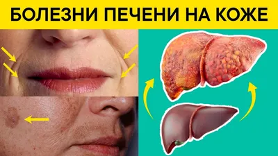 Цирроз печени – симптомы, первые признаки, причины, стадии и лечение у  женщин и мужчин