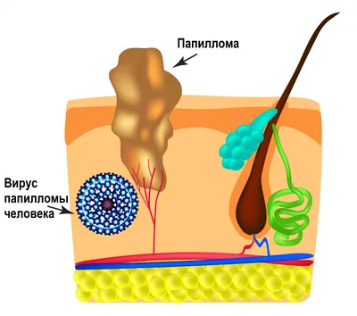 Бациллярный ангиоматоз: мониторинг лечения с помощью дерматоскопии |  DERMATOLOGY-ONLINE | Дзен