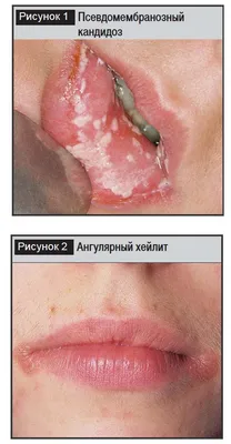 Ученые рассказали о пациентах, которым удалось контролировать ВИЧ без  лечения