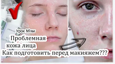 Уход за комбинированной/жирной кожи с акне, уход для проблемной кожи,  skincare | Акне, Кожа, Здоровье