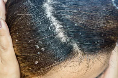 Болезни кожи головы: причины, последствия и лечение - Beauty HUB