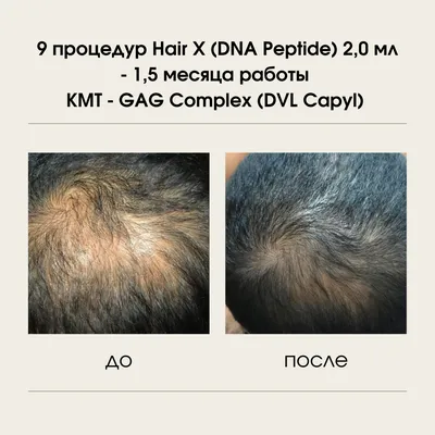 Заболевания волос у детей-Причины и лечение -Сентябрь 2022