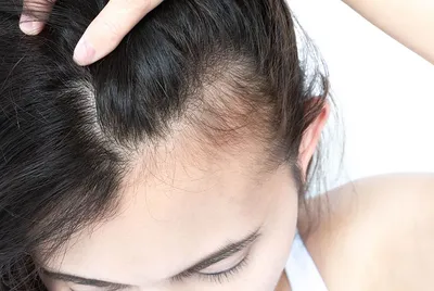 Косметолог Елена - К сожалению, не все проблемы с волосами можно решить с  помощью шампуней и масок. Фракционная мезотерапия кожи головы,  рекомендуется: ✓алопеция, ✓выпадение волос, ✓зуд кожи головы; ✓тонкие  волосы; ✓перхоть; ✓повышенная