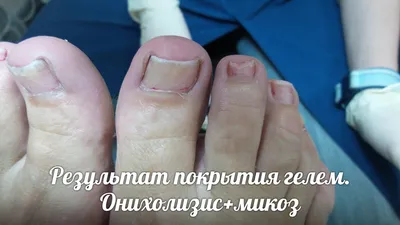 Медицинский педикюр в СПб | Nail Clinic