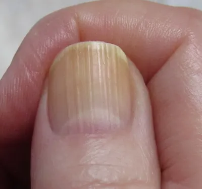 Продольные полоски на ногтях | ЗОЖ от питания к здоровью | Дзен