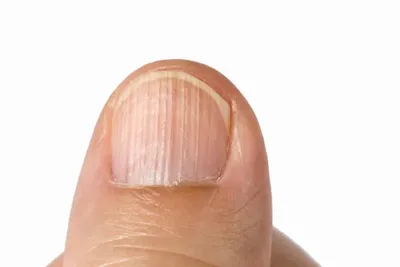 Лейконихия – что означают белые пятна на ногтях и как их лечить, симптомы,  причины появления и профилактика