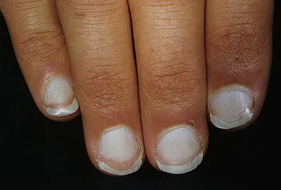 Что означают белые полосы на ногтях - ЗНАЙ ЮА