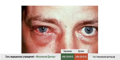 Воспаление глаз у взрослых и детей - YouTube