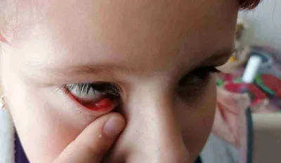 Капли для глаз Тобрисс - «Если у ребенка распух глаз» | отзывы