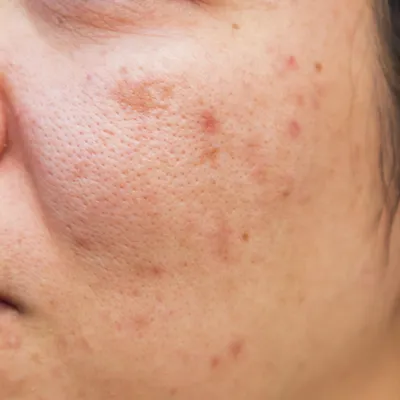 Аллергия на коже: симптомы и причины | Диагностика и лечение кожной аллергии  в АО «Медицина»