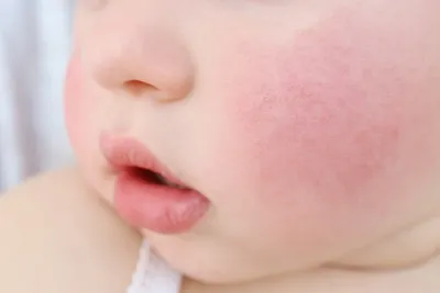 Сыпь у ребенка - Аллергоцентр