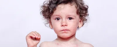 Аллергия у детей. Что такое аллергия
