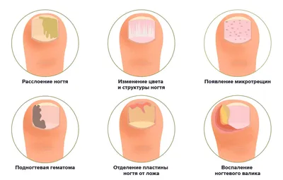 Первые симтомы псориаза | Psoriaz.Life | Дзен