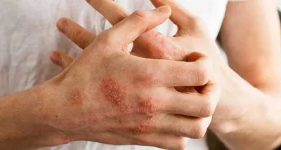 Псориаз - заболевание не только кожи...Что важно знать пациенту. |  Skinallergic.ru | Дзен