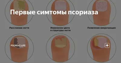 Psoriaz.life - Чем отличается «детский» псориаз от «взрослого»? ⠀ Псориаз —  распространенное хроническое воспалительное неинфекционное заболевание  кожи, которым одинаково часто страдают как взрослые, так и дети. ⠀ Почти в  трети случаев псориаз