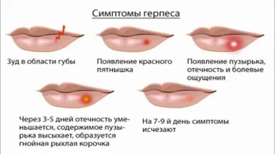 Лечение Герпеса на Теле у взрослых, препараты. Чем и как лечить герпес на  теле в домашних условиях - YouTube